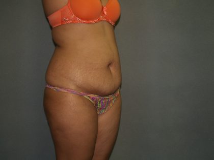 Tummy Tuck Before & After Patient #1919