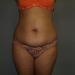 Tummy Tuck Before & After Patient #1919