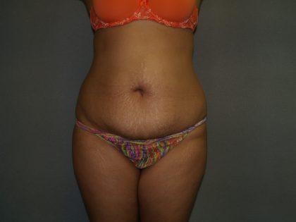 Tummy Tuck Before & After Patient #1919