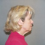 Facelift Before & After Patient #549
