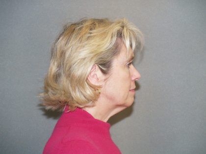 Facelift Before & After Patient #549