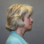 Facelift Before & After Patient #549