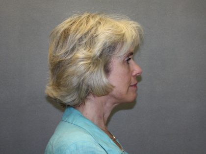 Facelift Before & After Patient #549