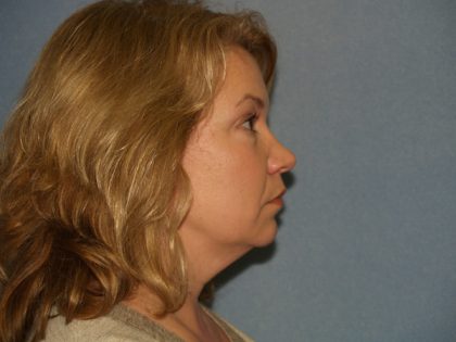 Facelift Before & After Patient #613