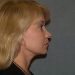 Facelift Before & After Patient #613