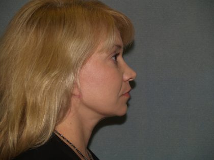 Facelift Before & After Patient #613