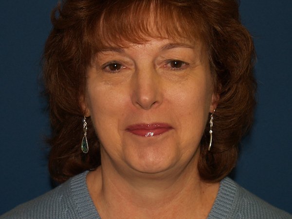 Facelift Before & After Patient #557