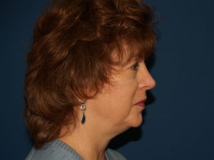 Facelift Before & After Patient #557