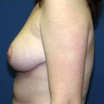 Breast Reduction Before & After Patient #3426