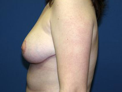 Breast Reduction Before & After Patient #3426