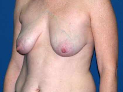 Breast Reconstruction Before & After Patient #1746