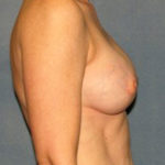 Breast Reconstruction Before & After Patient #1746