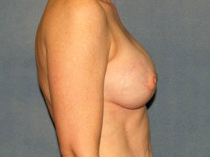 Breast Reconstruction Before & After Patient #1746