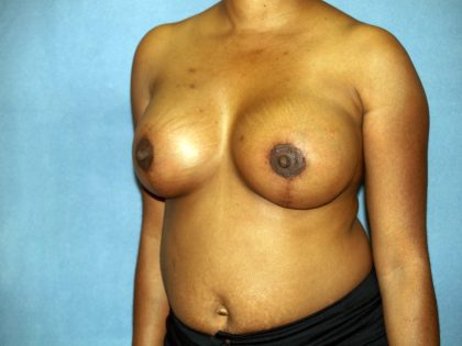 Breast Lift with Implant Before & After Patient #1523