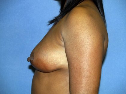 Breast Lift with Implant Before & After Patient #1523