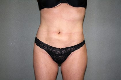 Liposuction Before & After Patient #3838