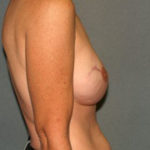 Breast Reconstruction Before & After Patient #2130