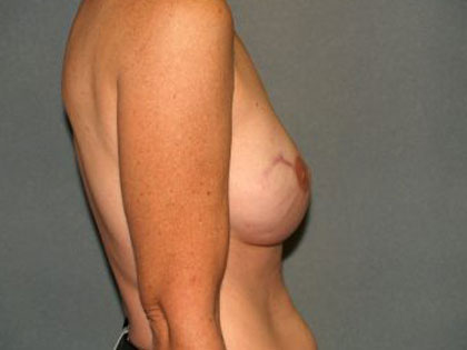 Breast Reconstruction Before & After Patient #2130