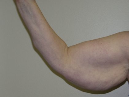 Arm Lift Before & After Patient #851