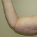 Arm Lift Before & After Patient #851