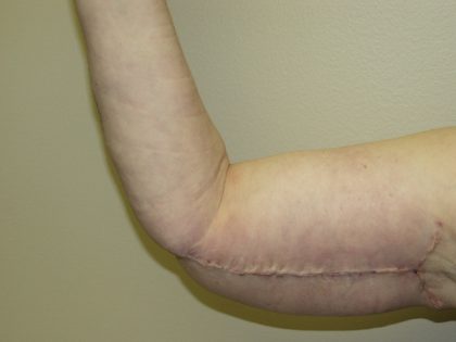 Arm Lift Before & After Patient #851