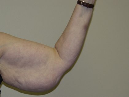 Arm Lift Before & After Patient #851