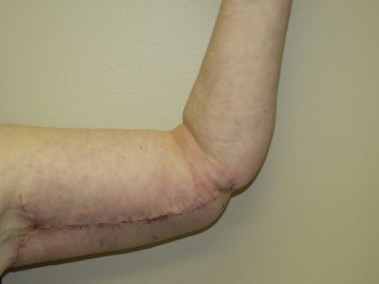 Arm Lift Before & After Patient #851