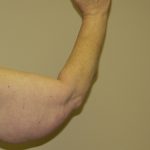 Arm Lift Before & After Patient #851