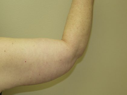 Arm Lift Before & After Patient #851