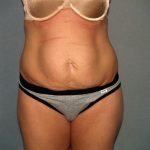 Tummy Tuck Before & After Patient #2280