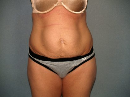 Tummy Tuck Before & After Patient #2280