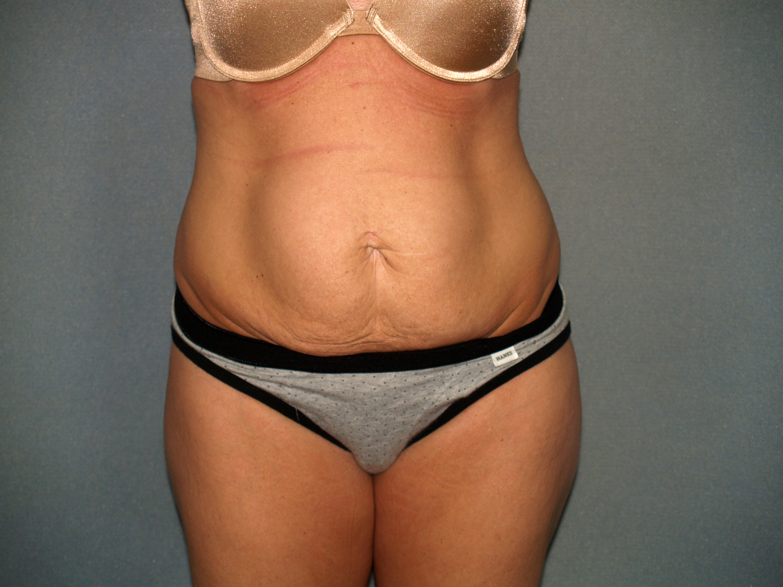 Tummy Tuck Before & After Patient #2280
