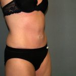Tummy Tuck Before & After Patient #2280