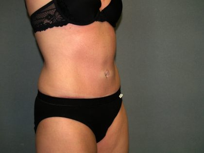 Tummy Tuck Before & After Patient #2280