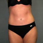 Tummy Tuck Before & After Patient #2280