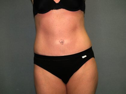 Tummy Tuck Before & After Patient #2280