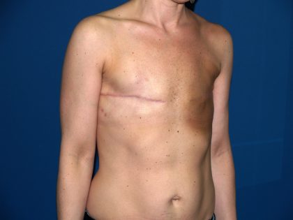 Breast Reconstruction Before & After Patient #2390
