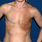 Breast Reconstruction Before & After Patient #2390