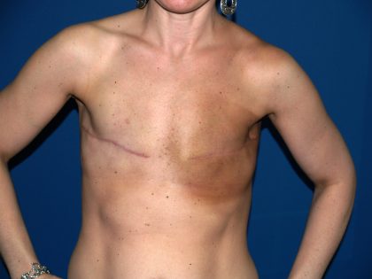 Breast Reconstruction Before & After Patient #2390