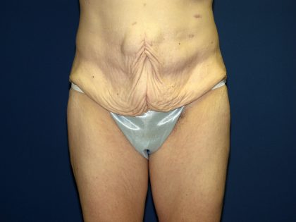 Circumferential Tummy Tuck Before & After Patient #884