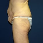 Circumferential Tummy Tuck Before & After Patient #884