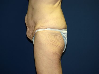 Circumferential Tummy Tuck Before & After Patient #884