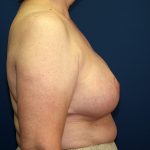 Breast Reduction Before & After Patient #3398