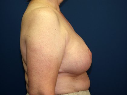 Breast Reduction Before & After Patient #3398