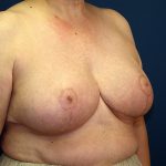 Breast Reduction Before & After Patient #3398