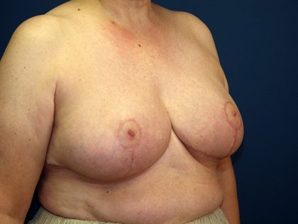 Breast Reduction Before & After Patient #3398