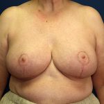 Breast Reduction Before & After Patient #3398