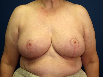 Breast Reduction Before & After Patient #3398