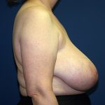 Breast Reduction Before & After Patient #3398