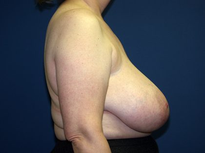 Breast Reduction Before & After Patient #3398